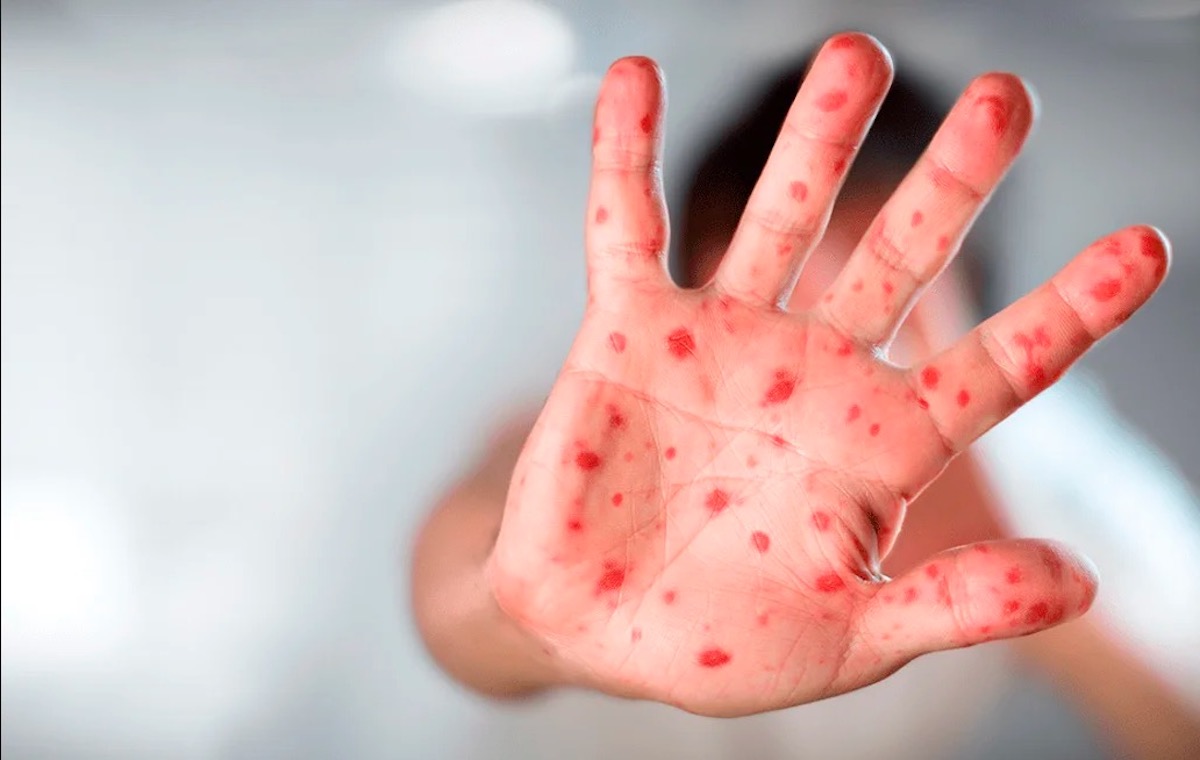 México reporta cuatro nuevos casos de mpox en una semana