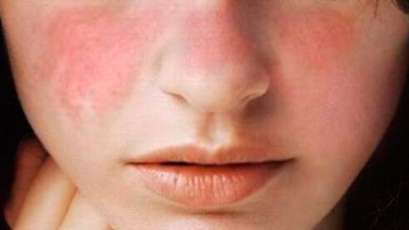Destaca IMSS Sonora signos de alerta sobre enfermedad de lupus